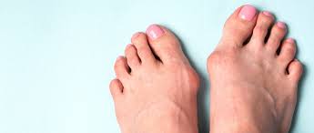 درمان بیماری هالوکس والگوس یا کجی شست پا توسط دکتر رجایی
برای  گرفتن نوبت روی عکس  کلیک کنید.

