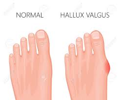 درمان بیماری هالوکس والگوس یا کجی شست پا توسط دکتر رجایی